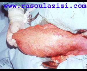 تصوير روده بزرگ سمي شده که توسط عمل جراحي از بدن بيمار خارج شده است
