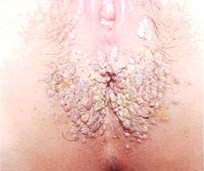 Anal Warts - Colorectal Disease